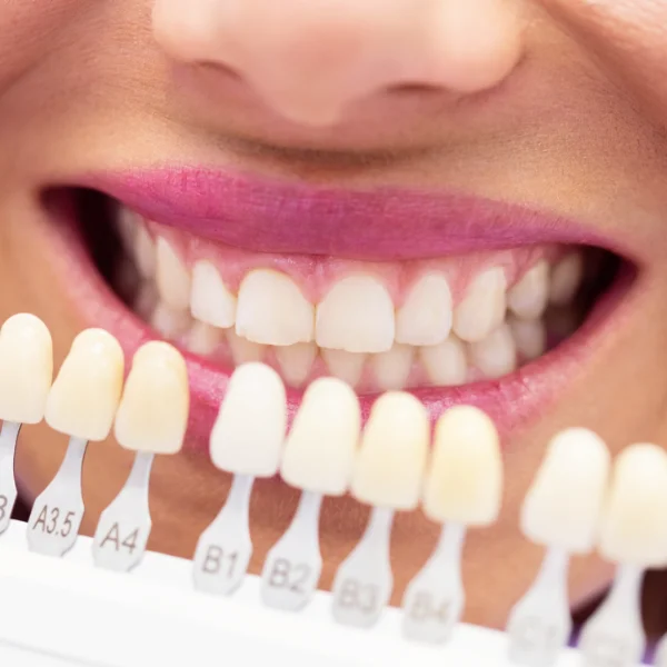 Clinica Minutilli | Faccette dentali