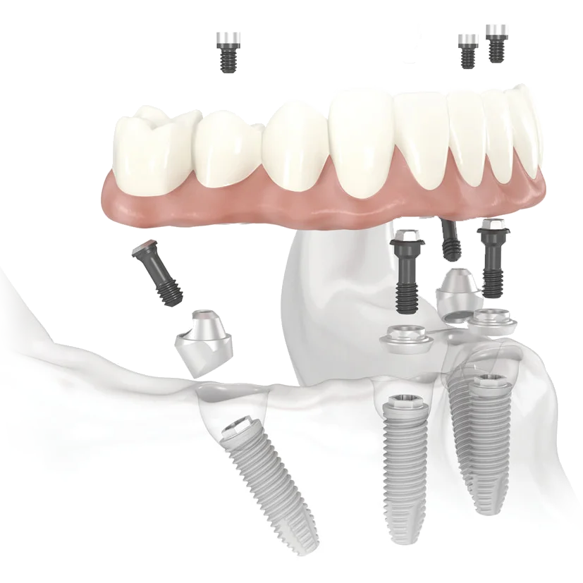 Clinica Minutilli | Impianto dentale a carico immediato